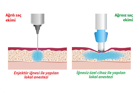 Ağrısız Saç Ekimi